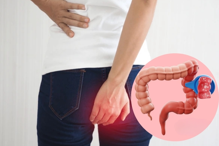 Anorectal Disease Management------30